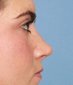 Real patient Rhinoplasty procedure after photo