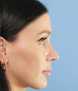 Real patient Rhinoplasty procedure after photo