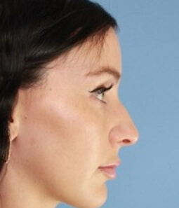 Real patient Rhinoplasty procedure before photo