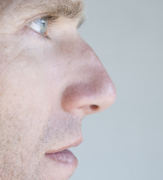 Male rhinoplasty real patient before and after gallery