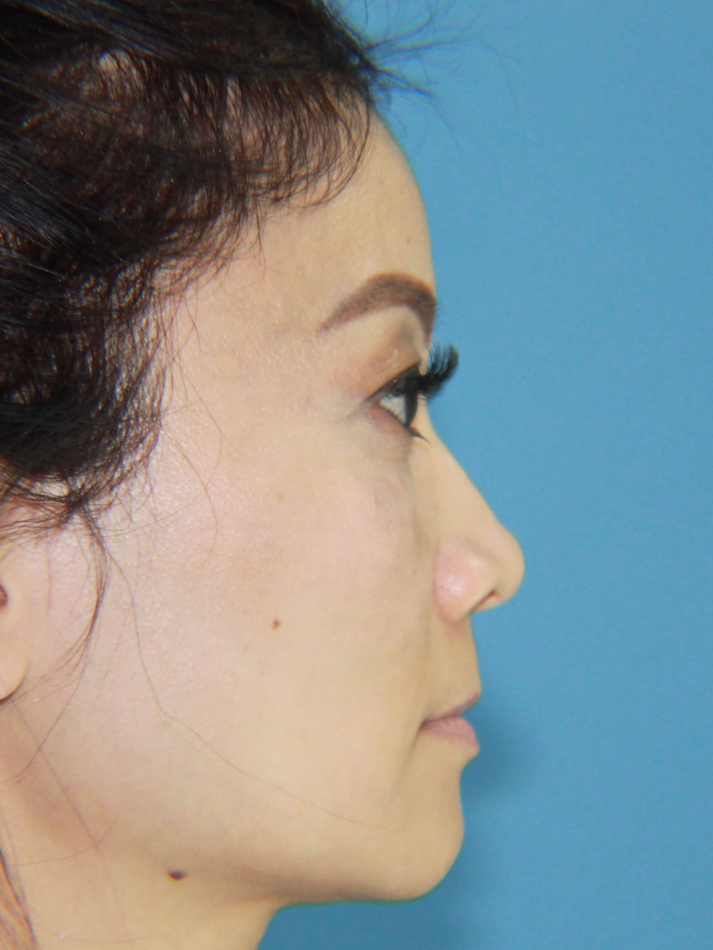 Asian Rhinoplasty real patient case photo