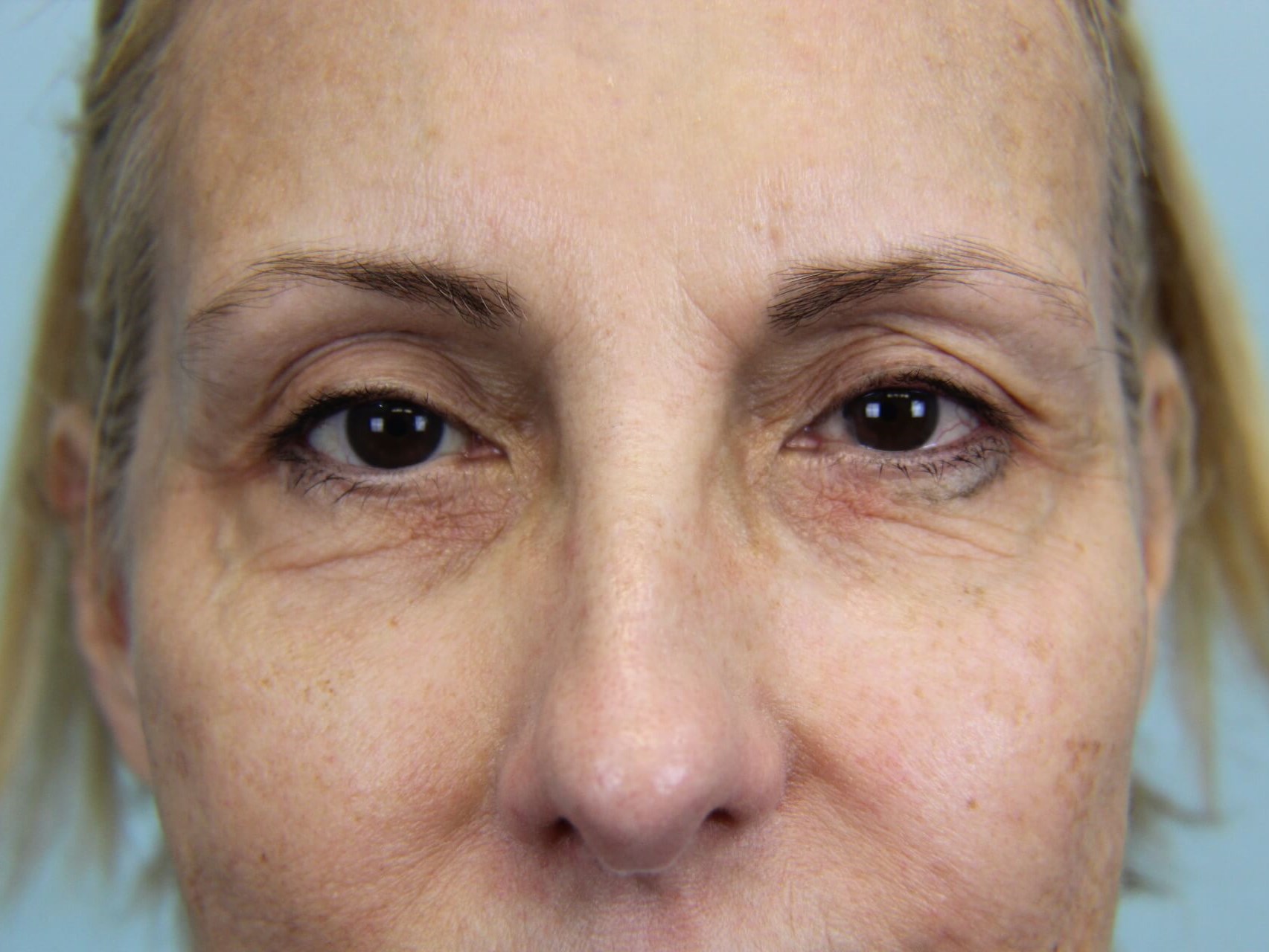 Facial Peels real patient case photo