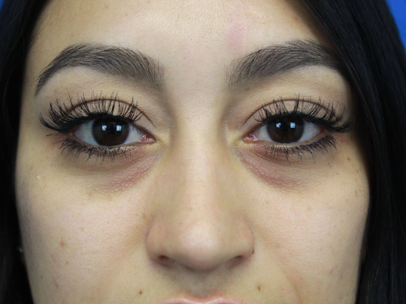 Tear Trough / Under Eye Filler real patient case photo