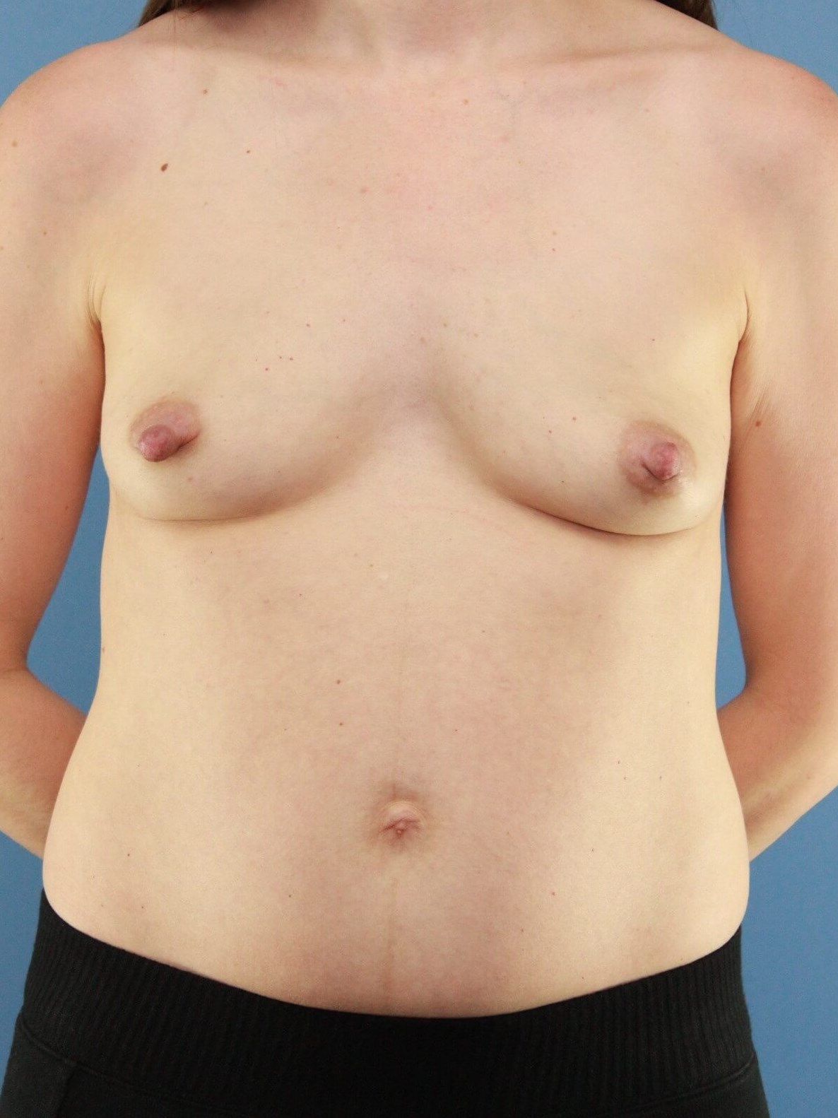 Breast Reconstruction real patient case photo