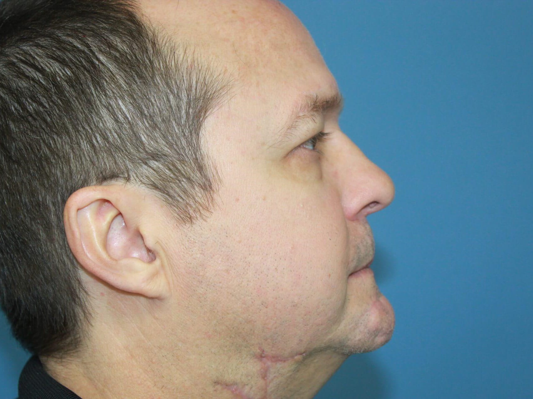 Facial Reconstruction real patient case photo