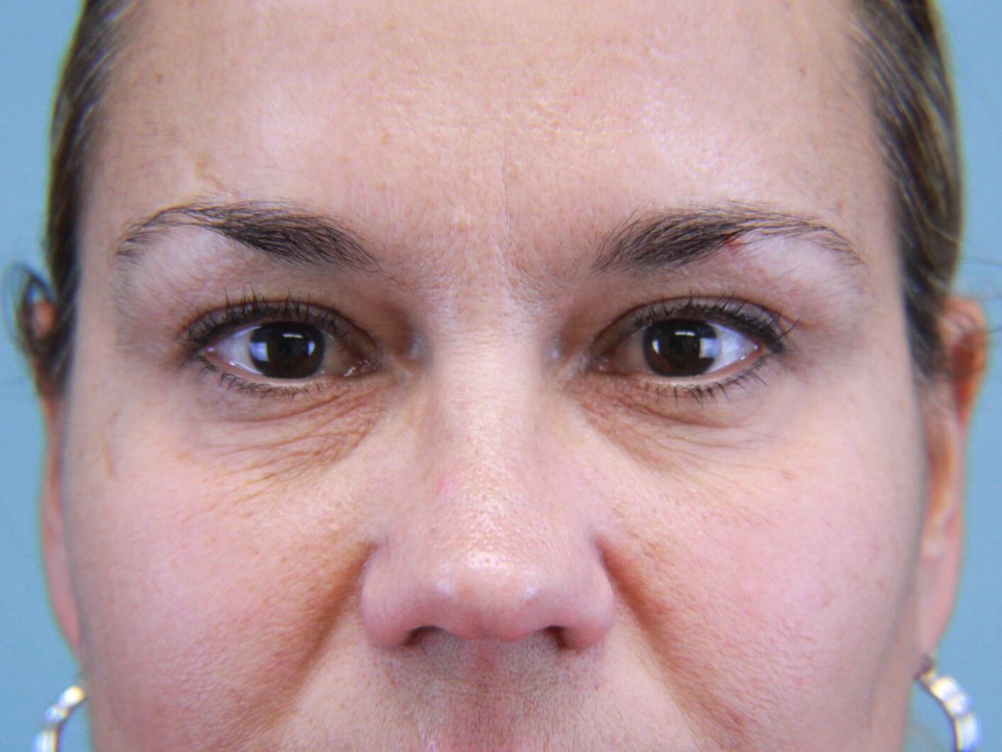Tear Trough / Under Eye Filler real patient case photo