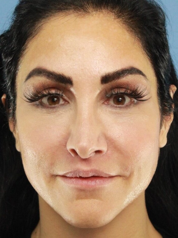 Cheek Fillers real patient case photo
