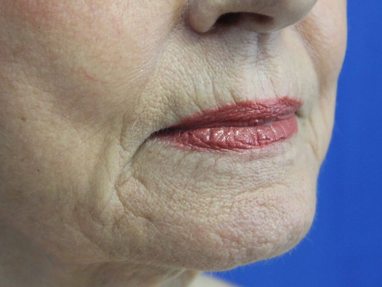 Cheek Fillers real patient case photo