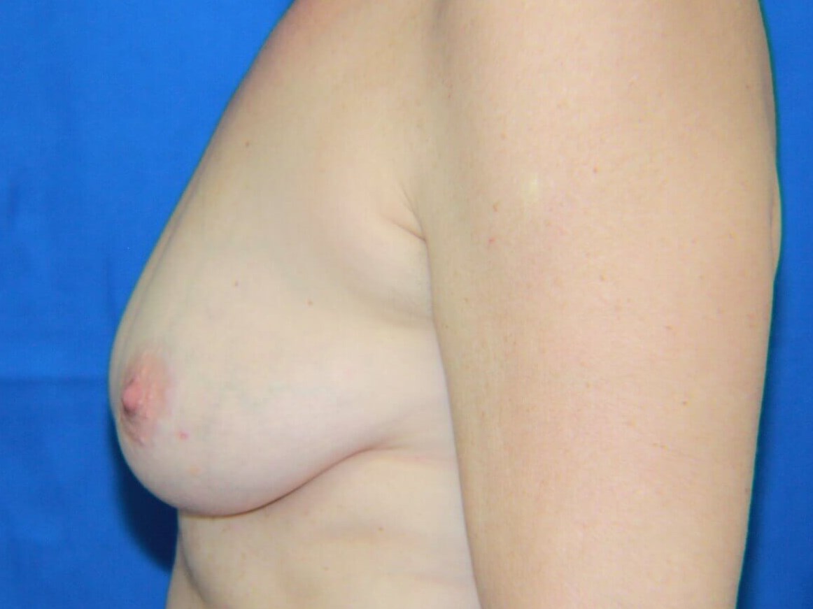 Breast Reconstruction real patient case photo
