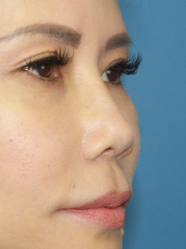 Asian Rhinoplasty real patient case photo