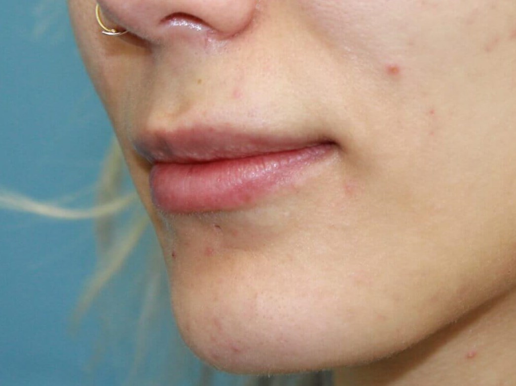 Lip Fillers real patient case photo