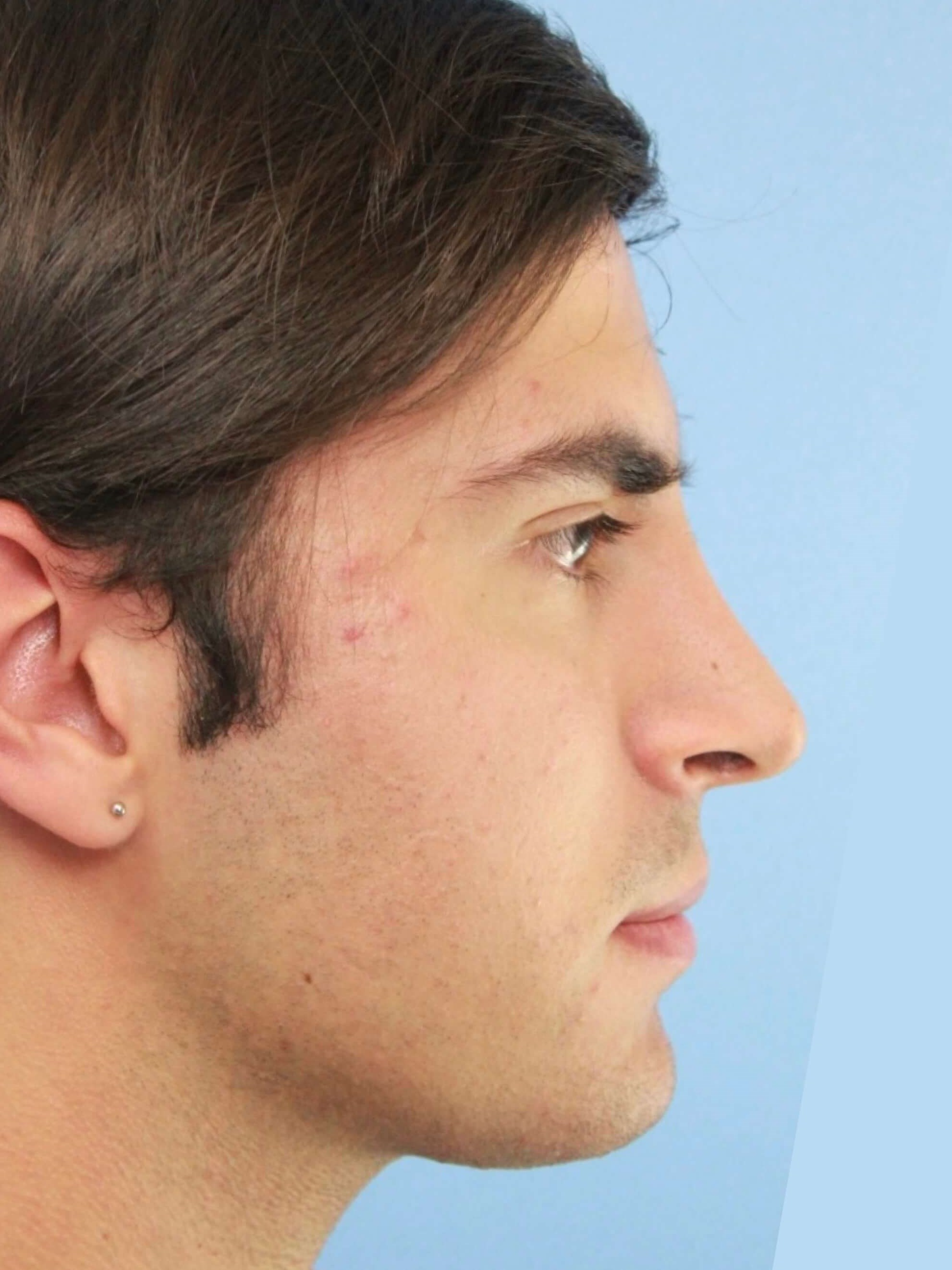 Revision Rhinoplasty real patient case photo
