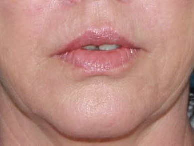 Lip Lift real patient case photo