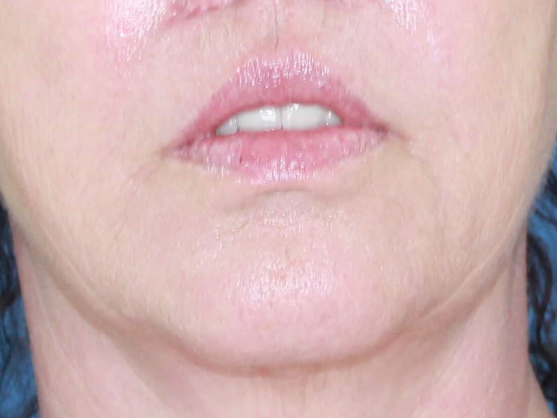 Lip Lift real patient case photo