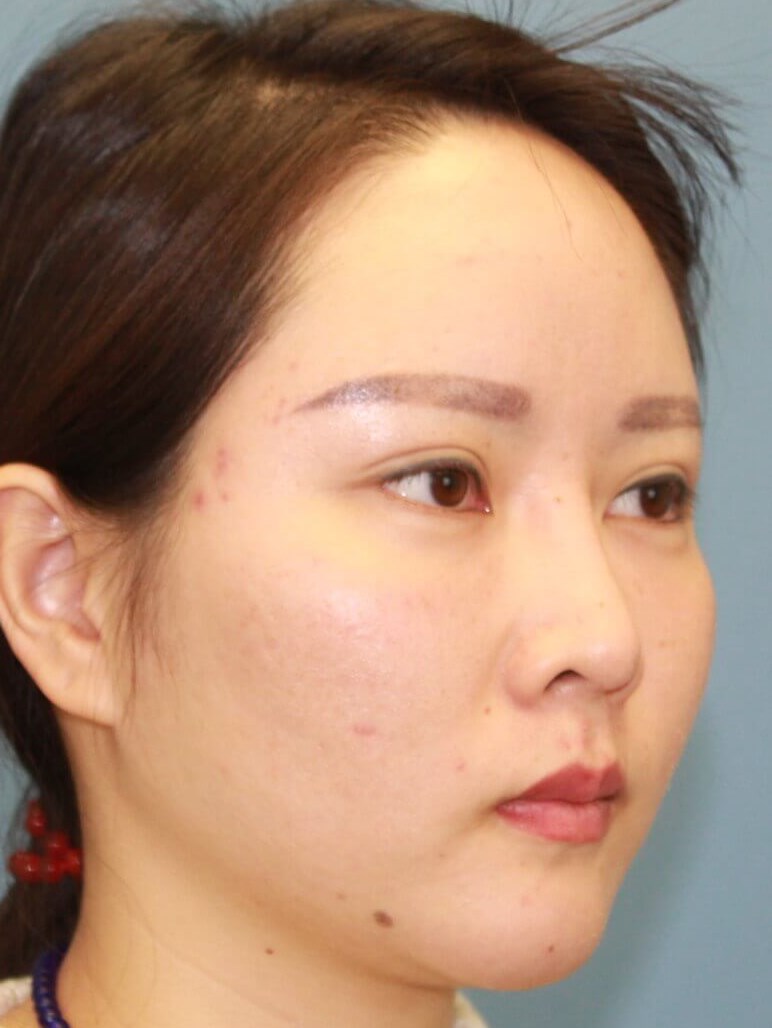 Revision Rhinoplasty real patient case photo