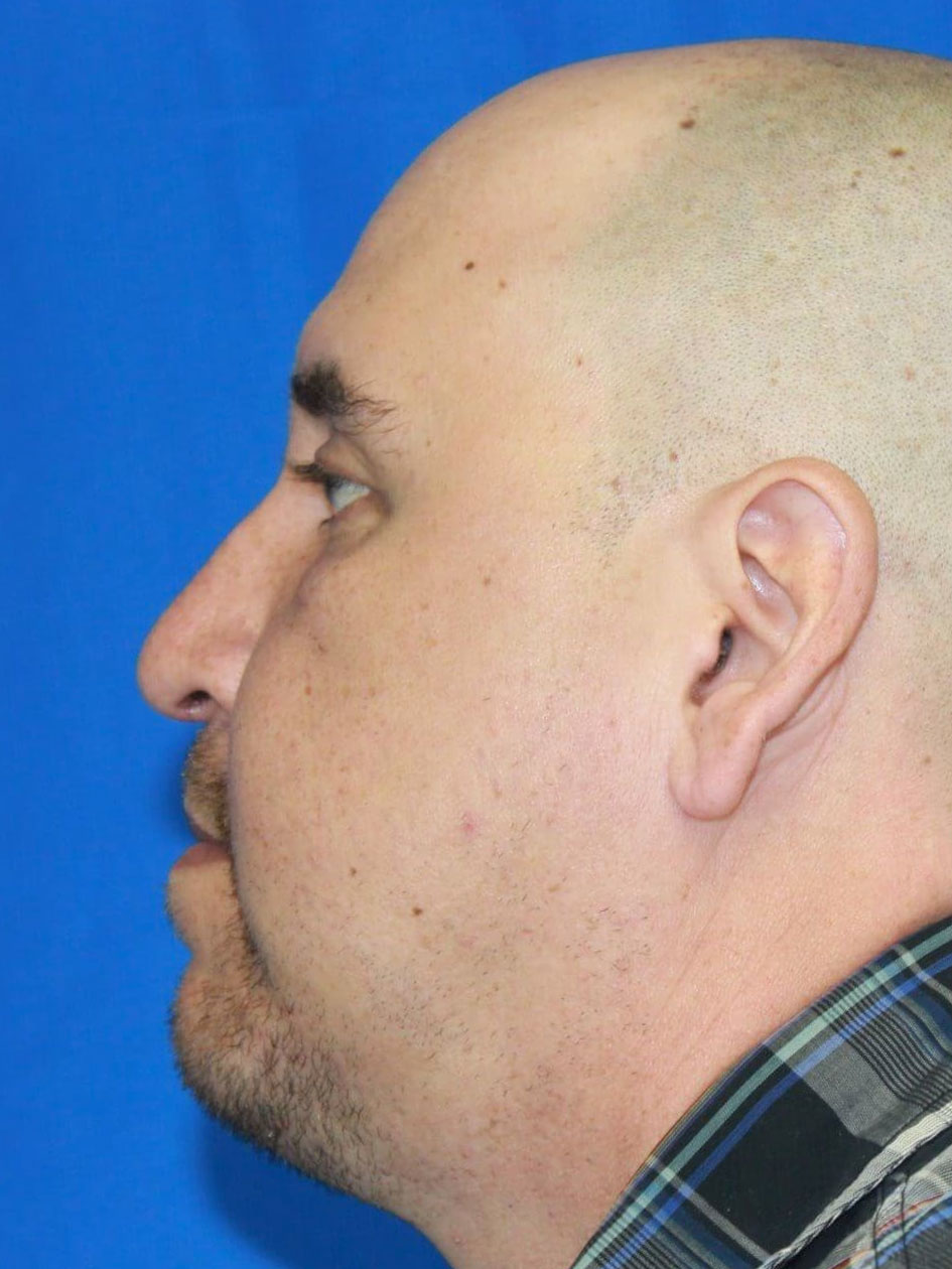 Rhinoplasty real patient case photo
