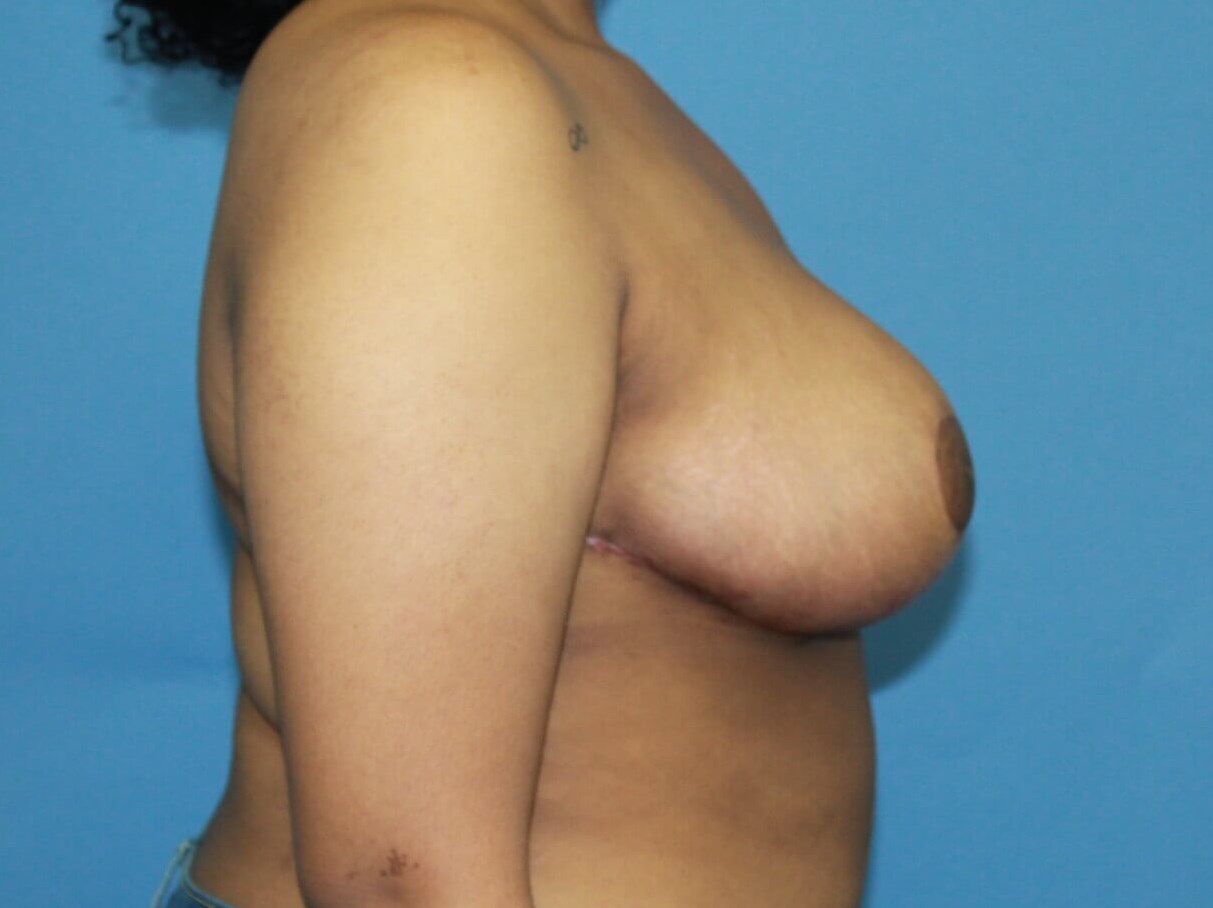 Breast Reduction real patient case photo