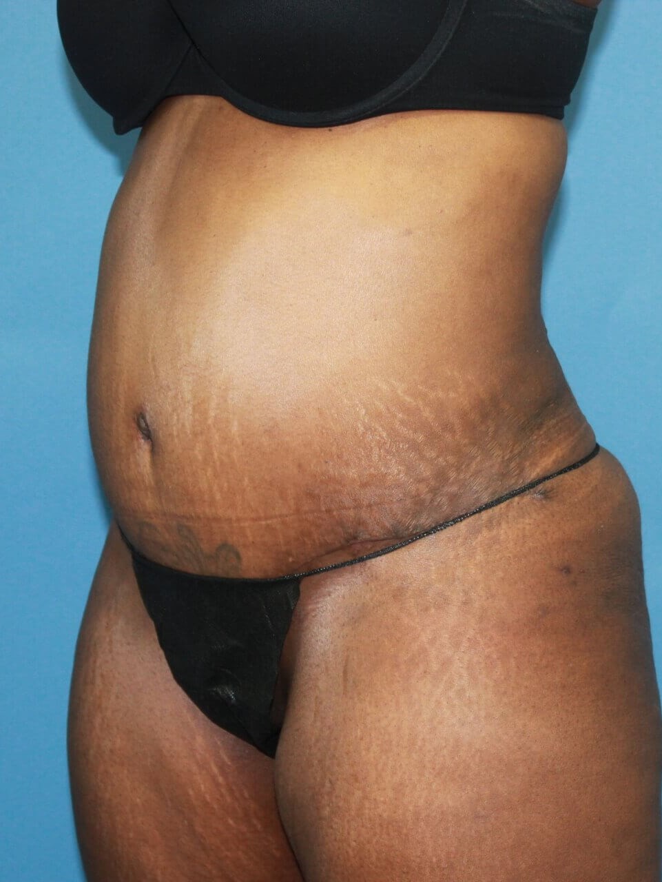 Liposuction real patient case photo