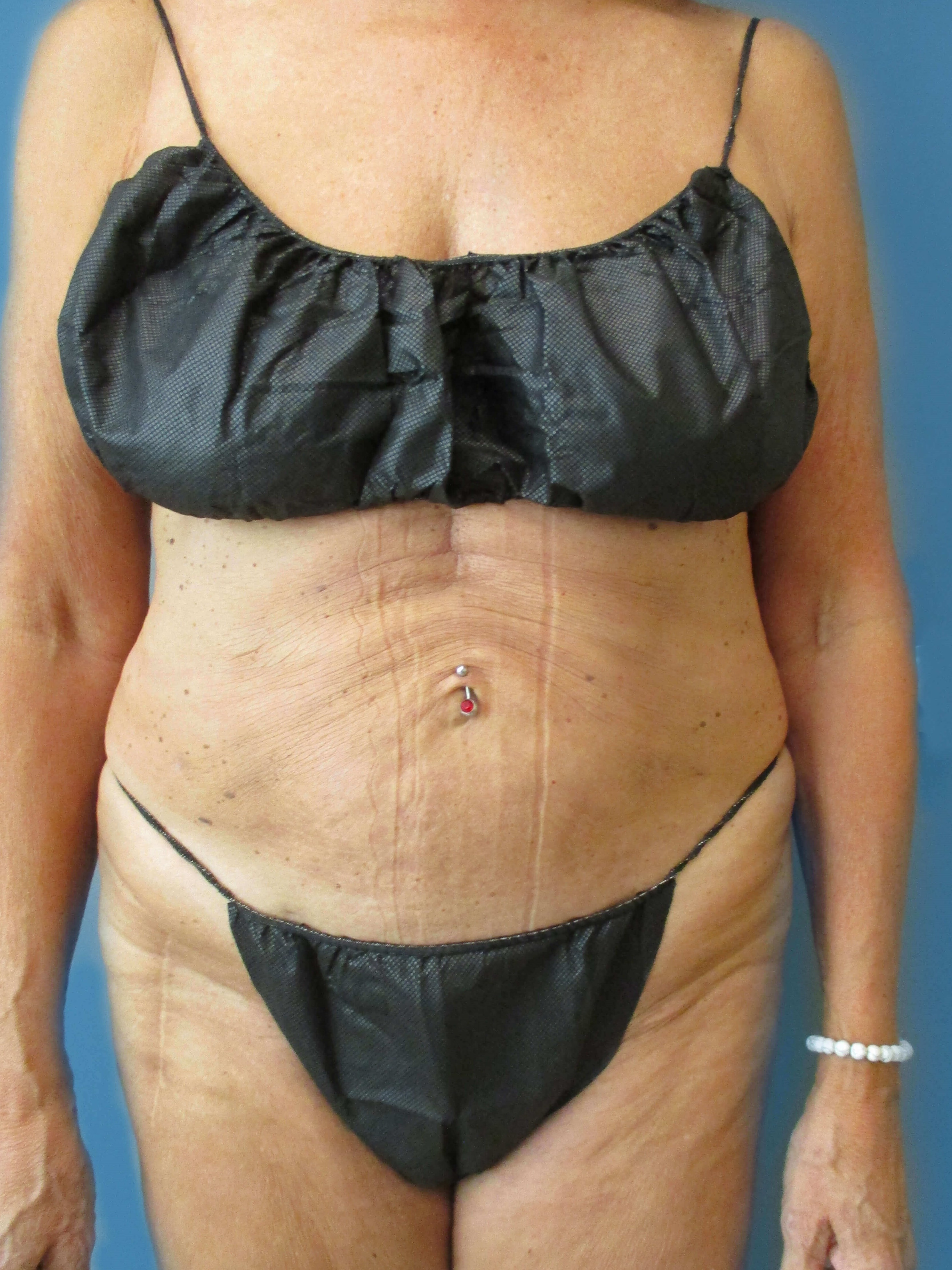 Liposuction