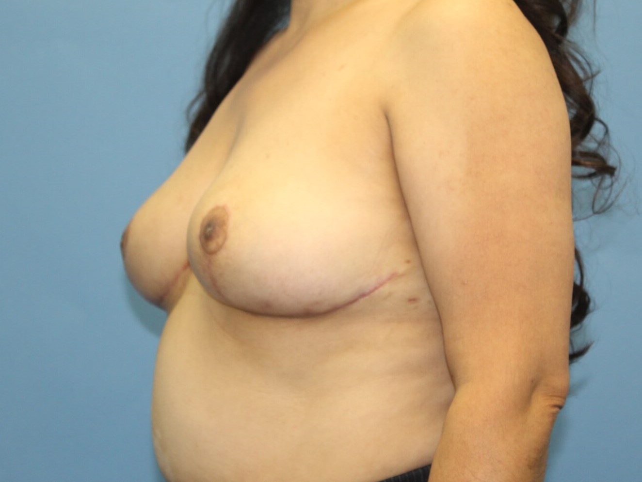 Breast Revision real patient case photo