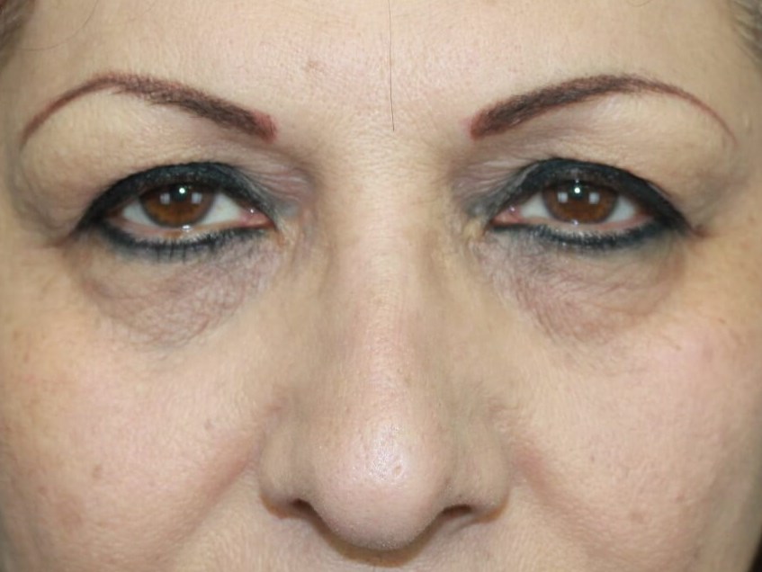 Eyelid Surgery real patient case photo