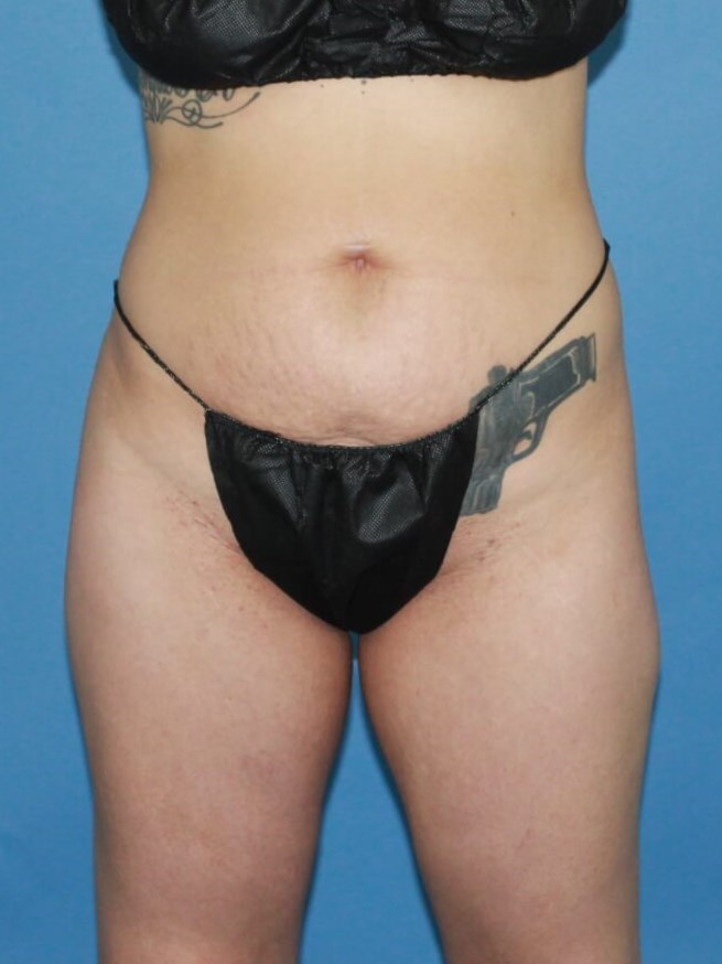 Mini Tummy Tuck real patient case photo