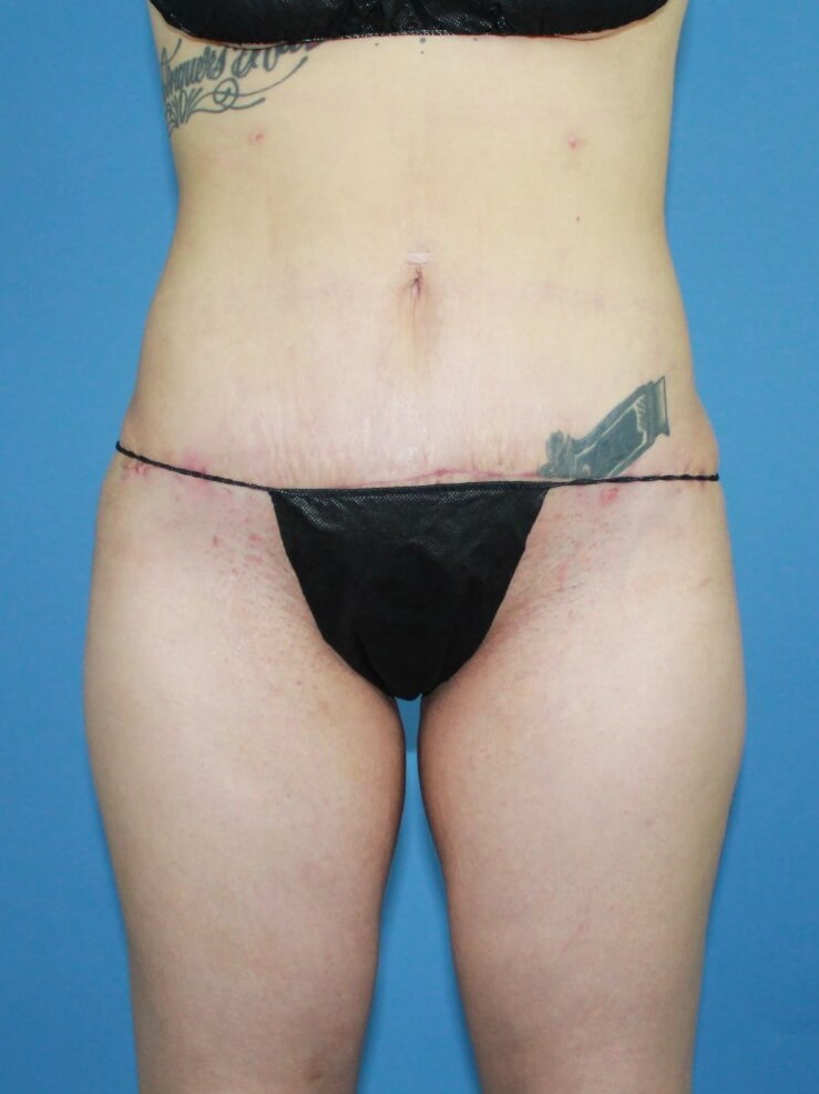 Mini Tummy Tuck real patient case photo