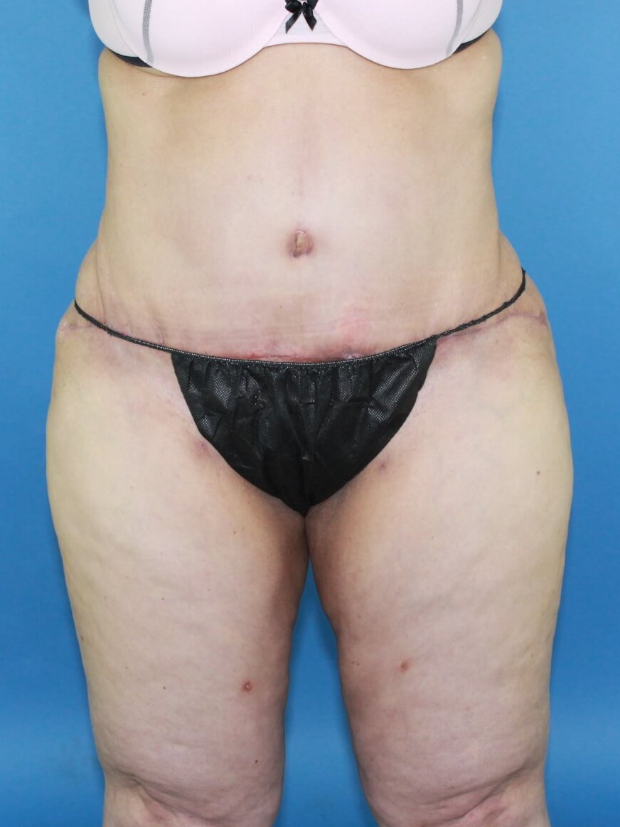 Liposuction