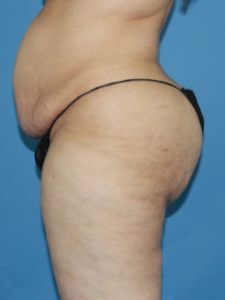 Liposuction