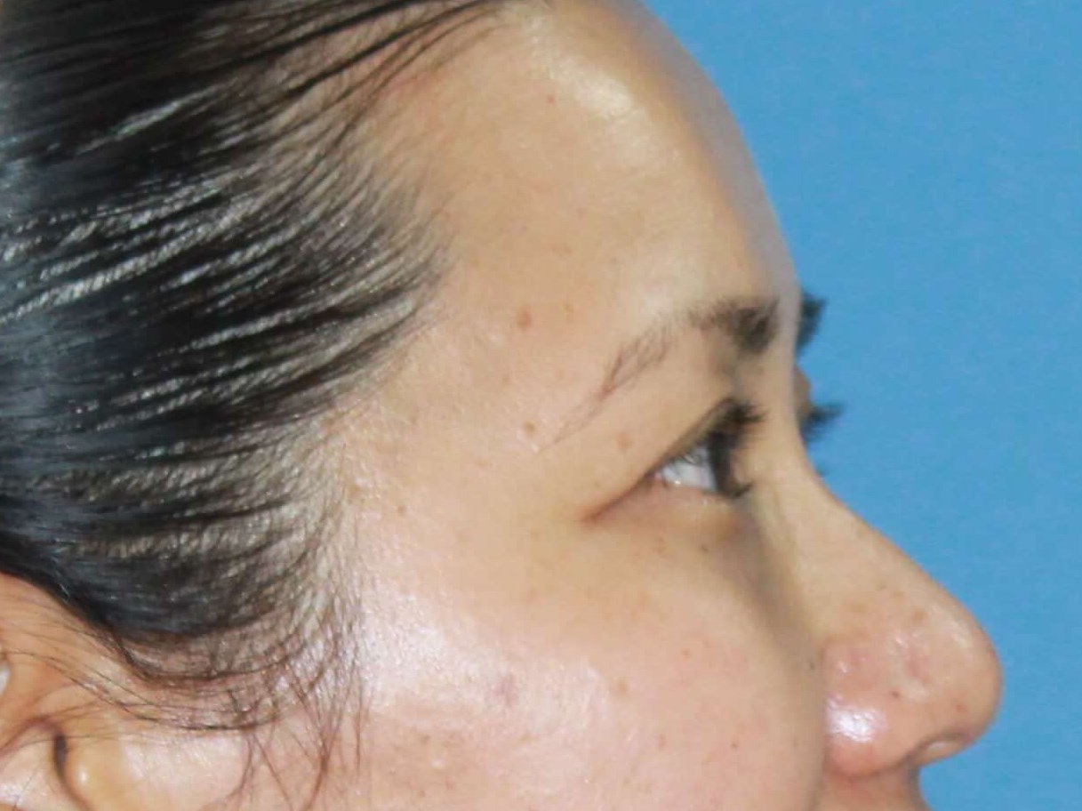 Asian Eyelid Surgery