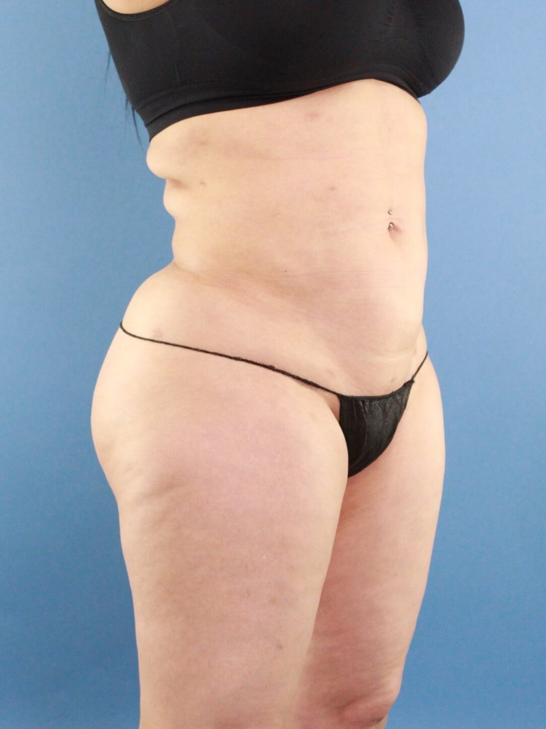 Liposuction