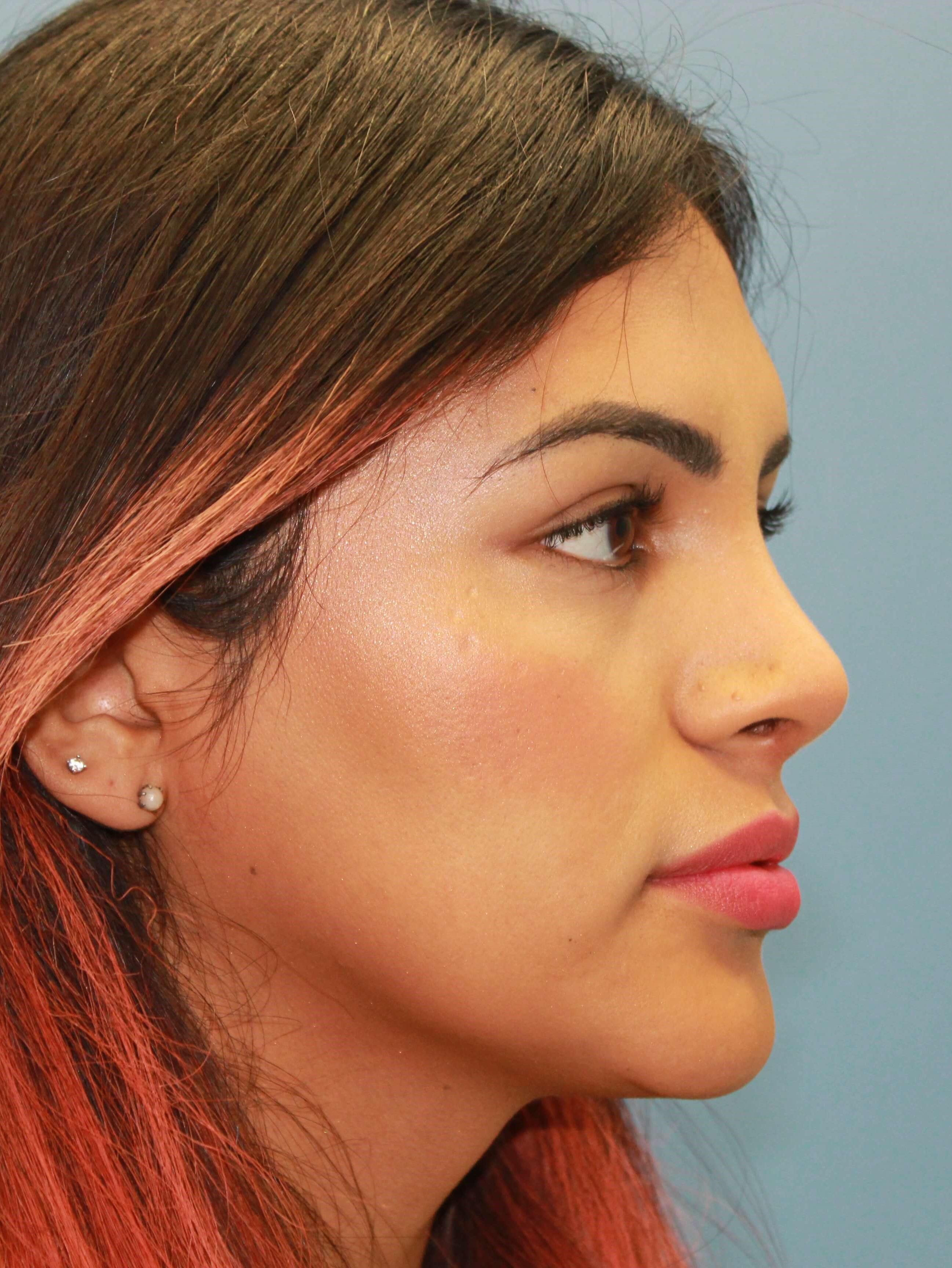 Rhinoplasty