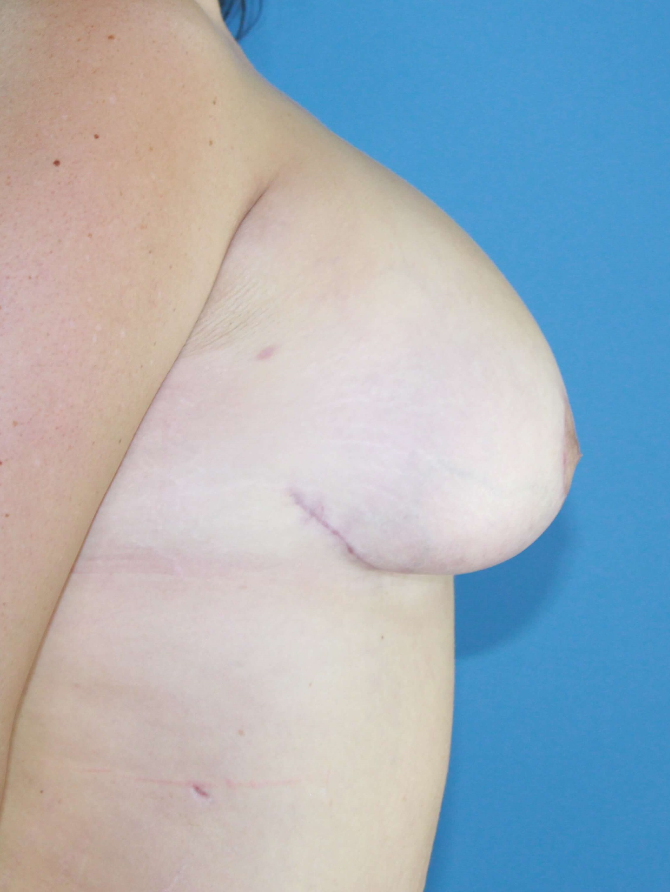 Breast Augmentation + Lift real patient case photo