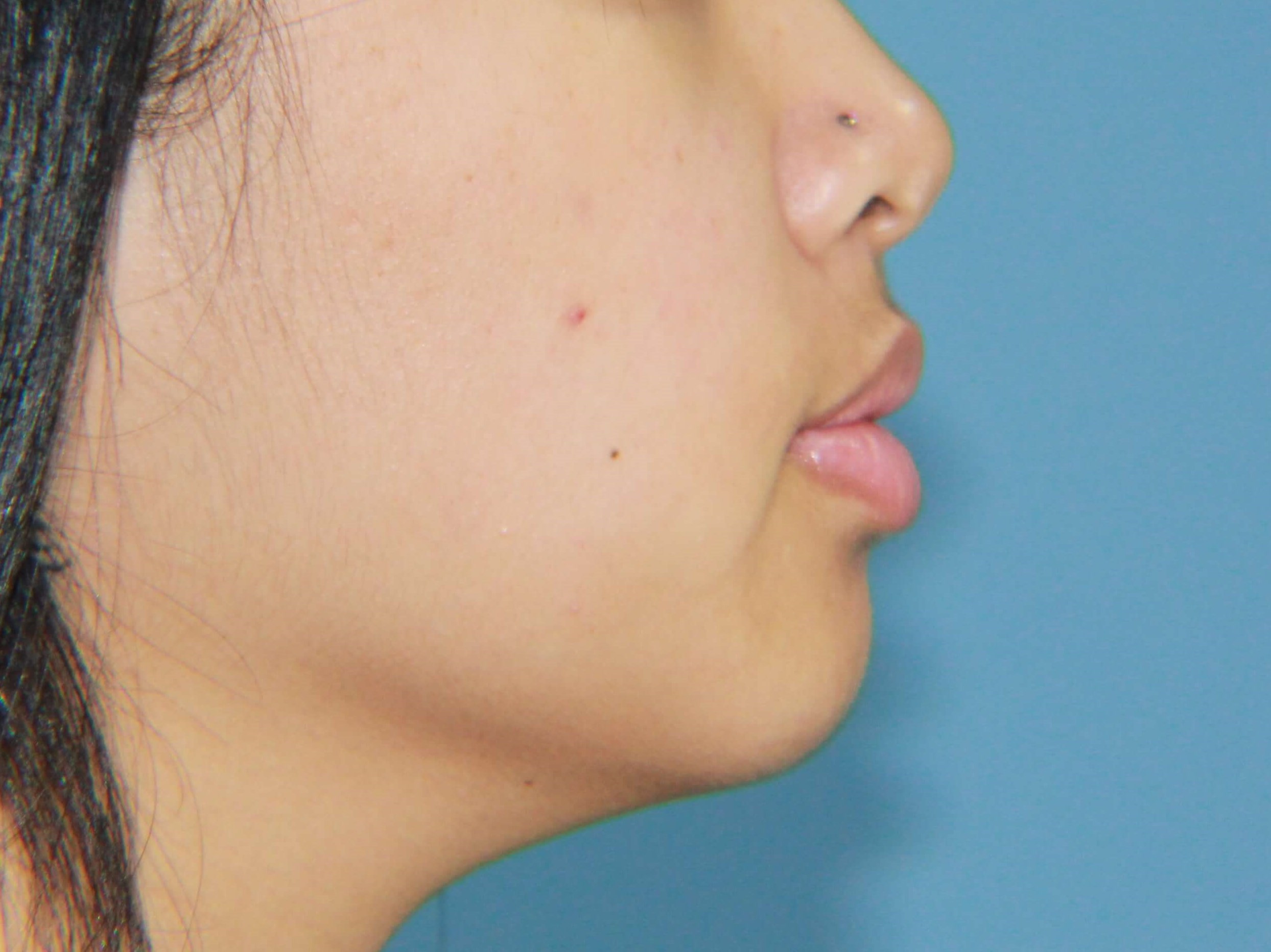 Buccal Fat Removal and V Line