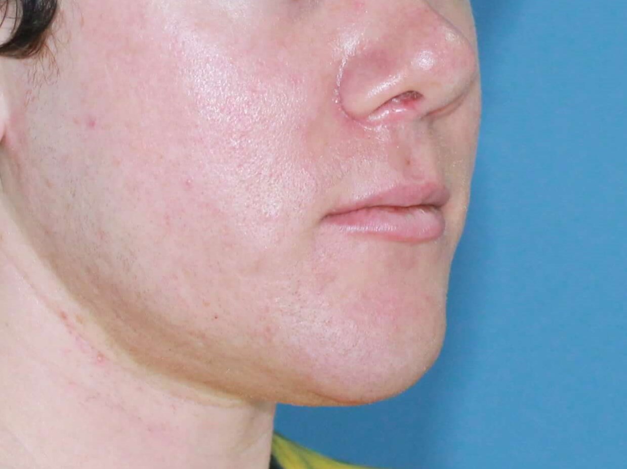 Chin Augmentation real patient case photo
