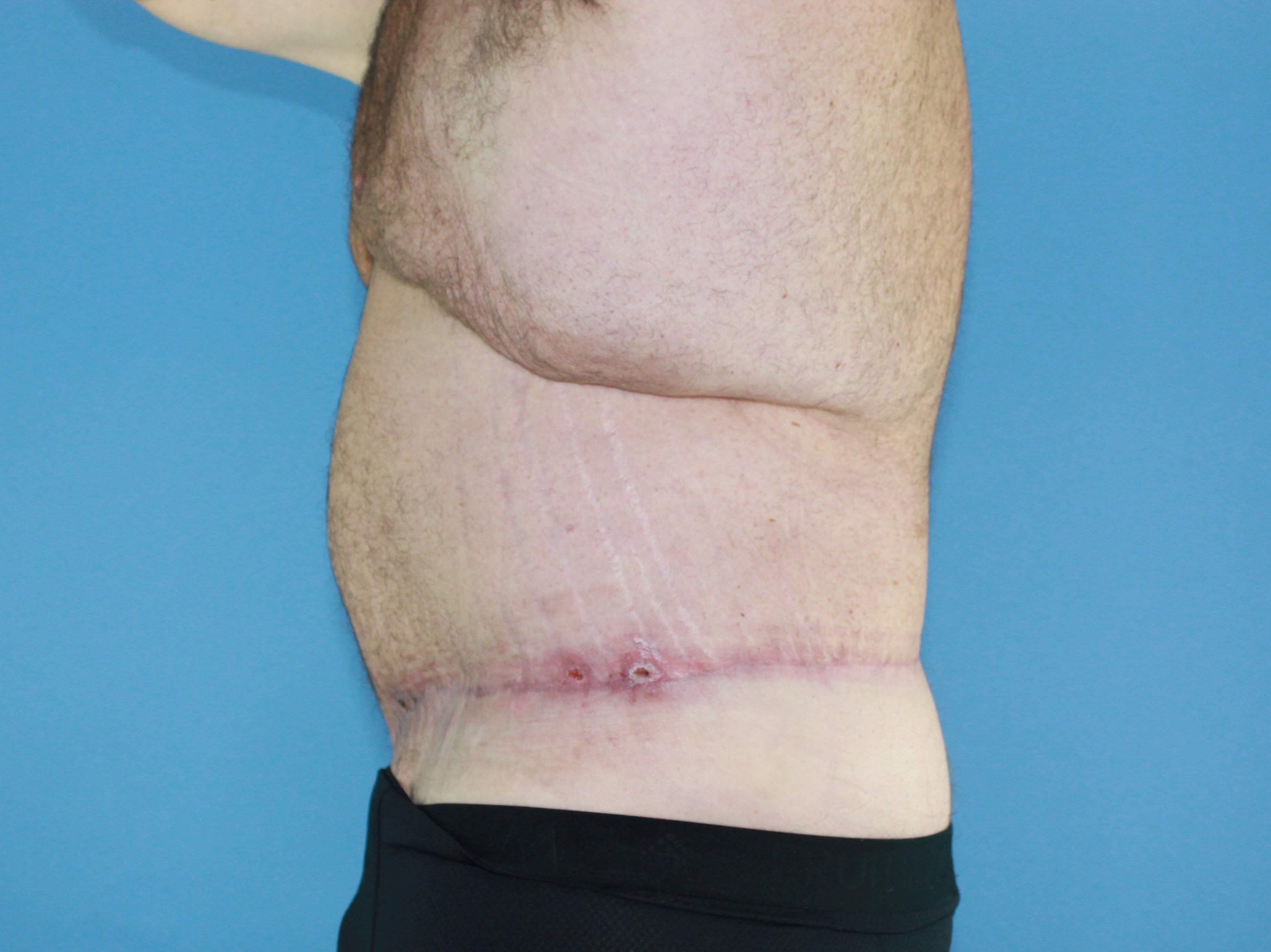 Male Tummy Tuck real patient case photo