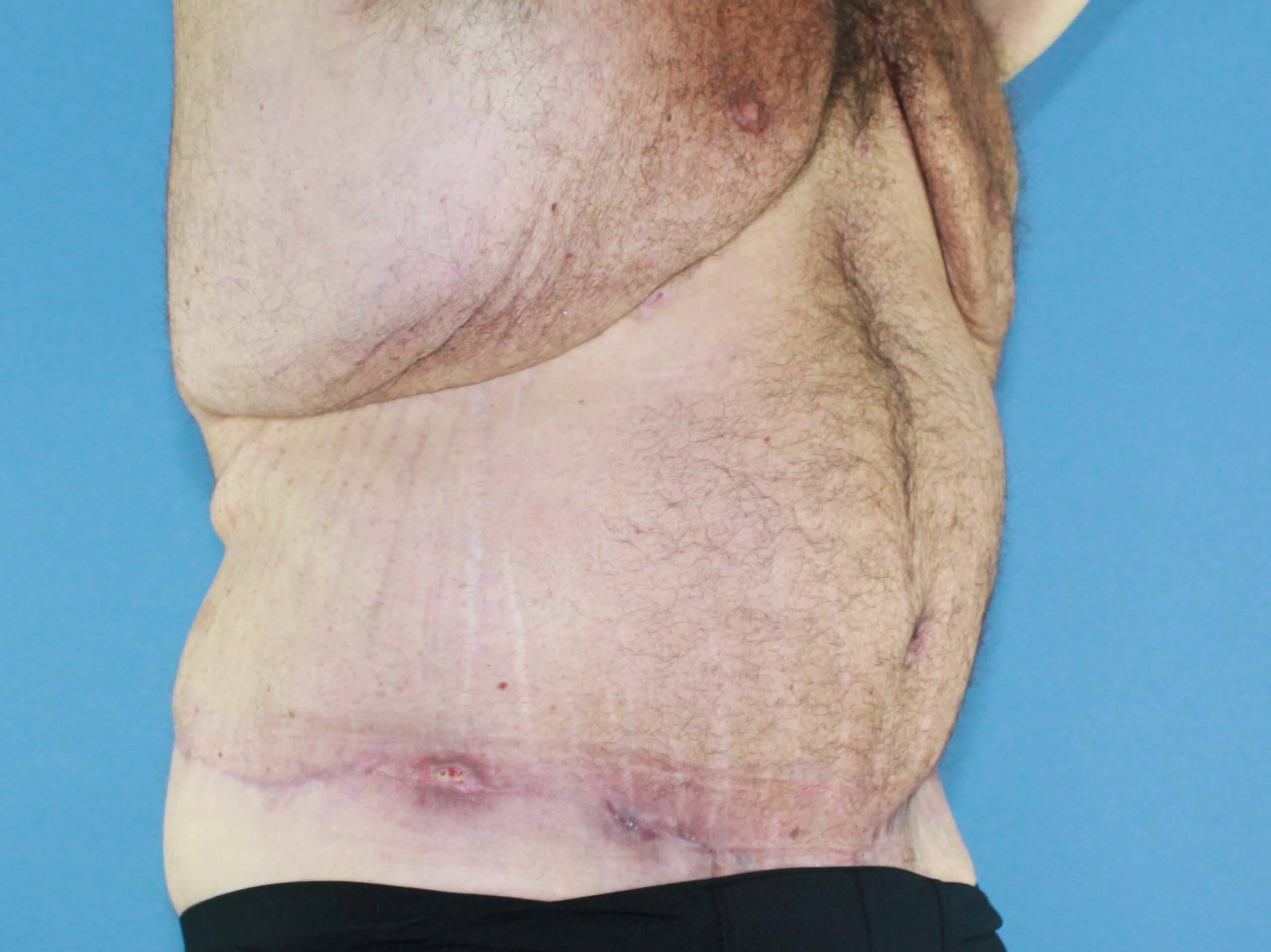 After Weight Loss Surgery real patient case photo