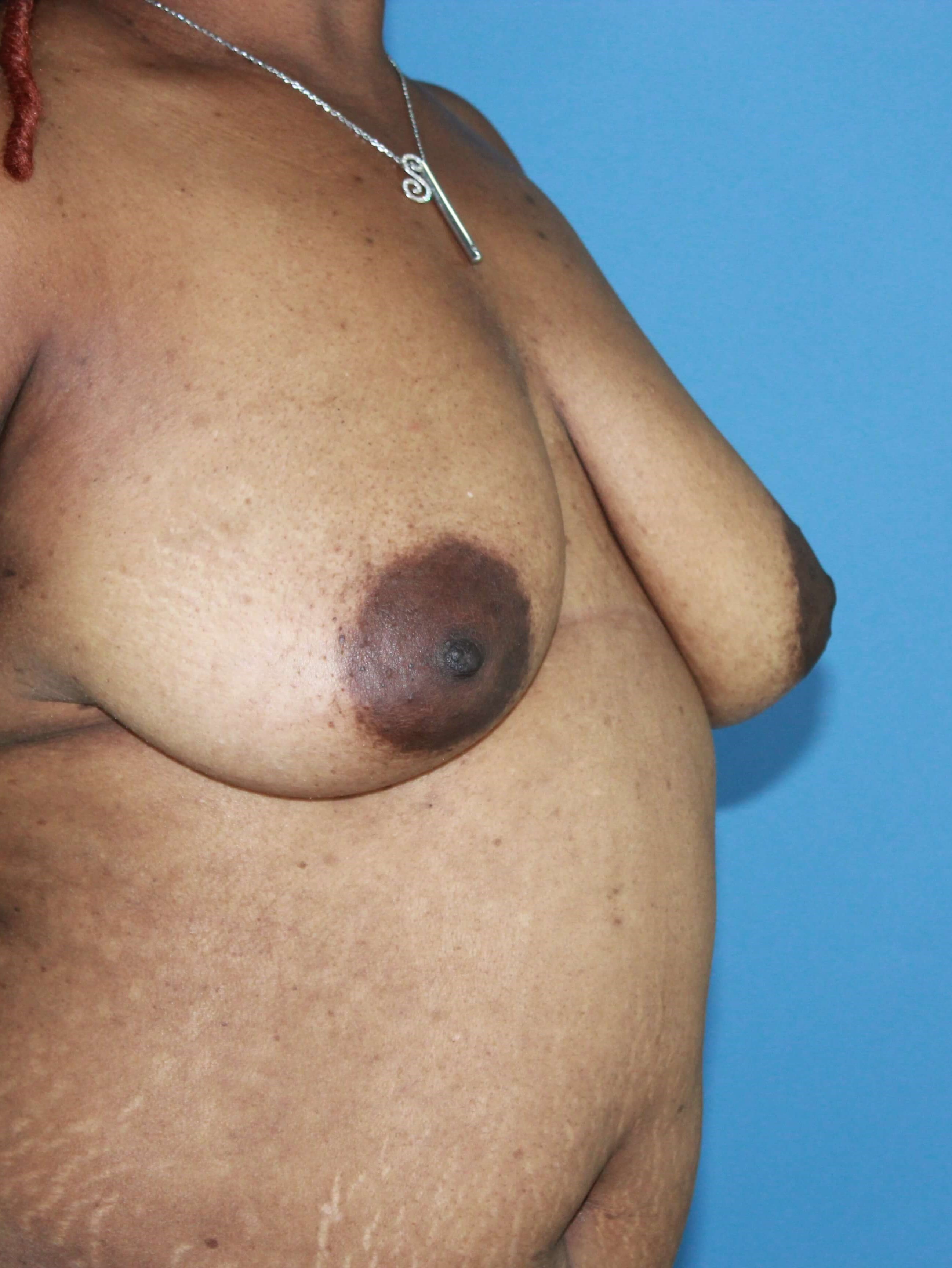 Breast Augmentation + Lift