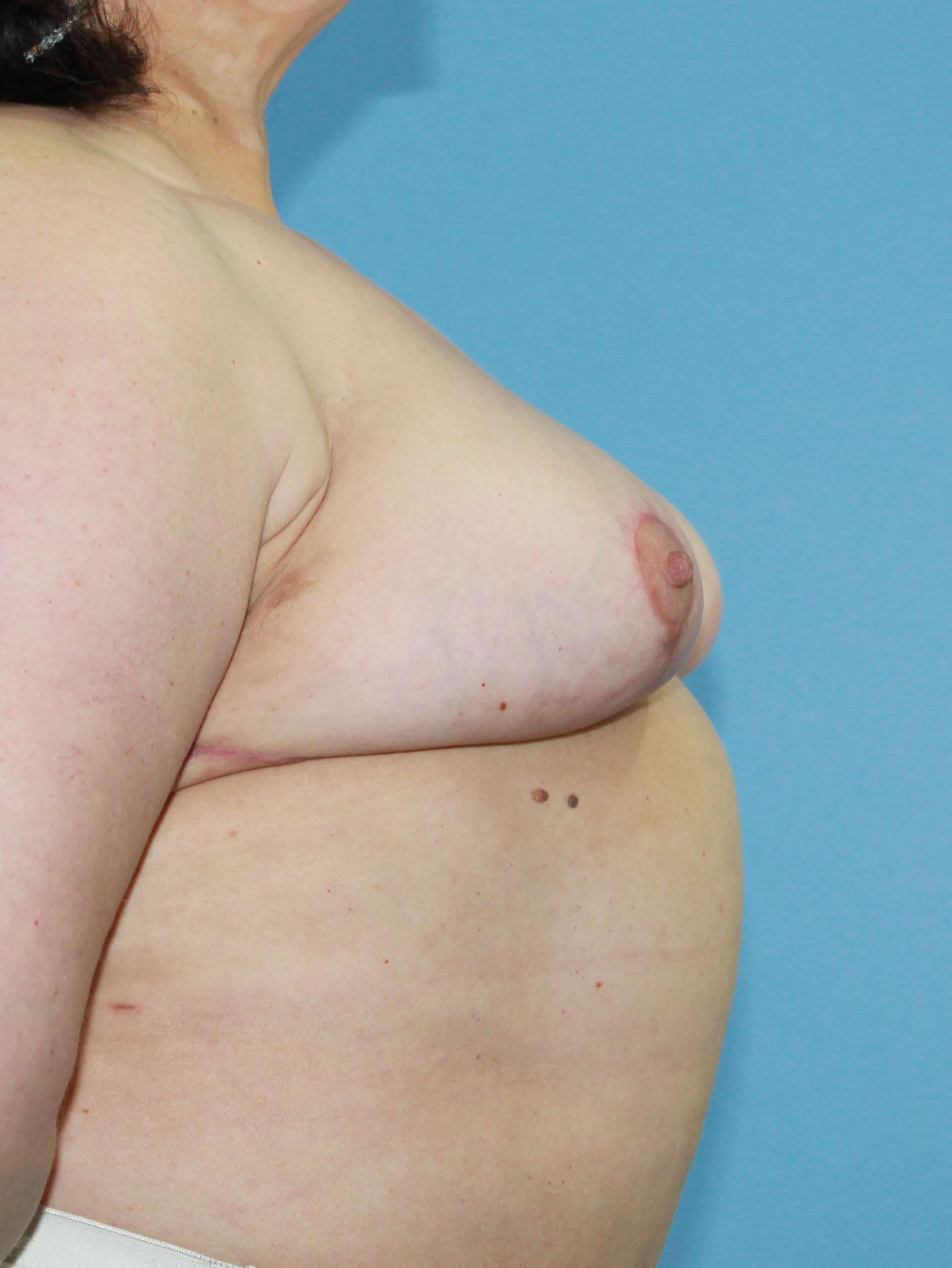 Breast Revision real patient case photo