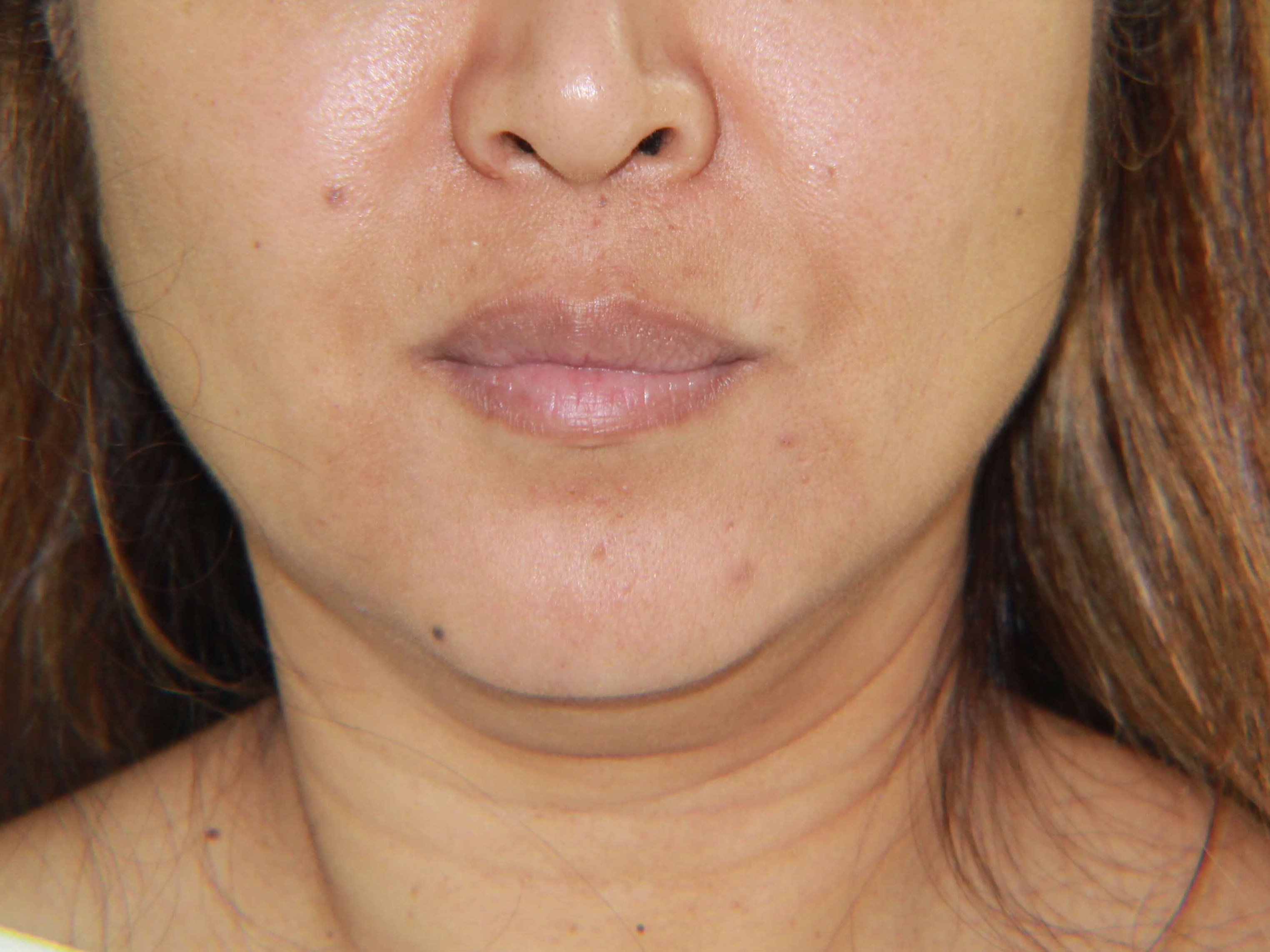 Buccal Fat Removal and V Line