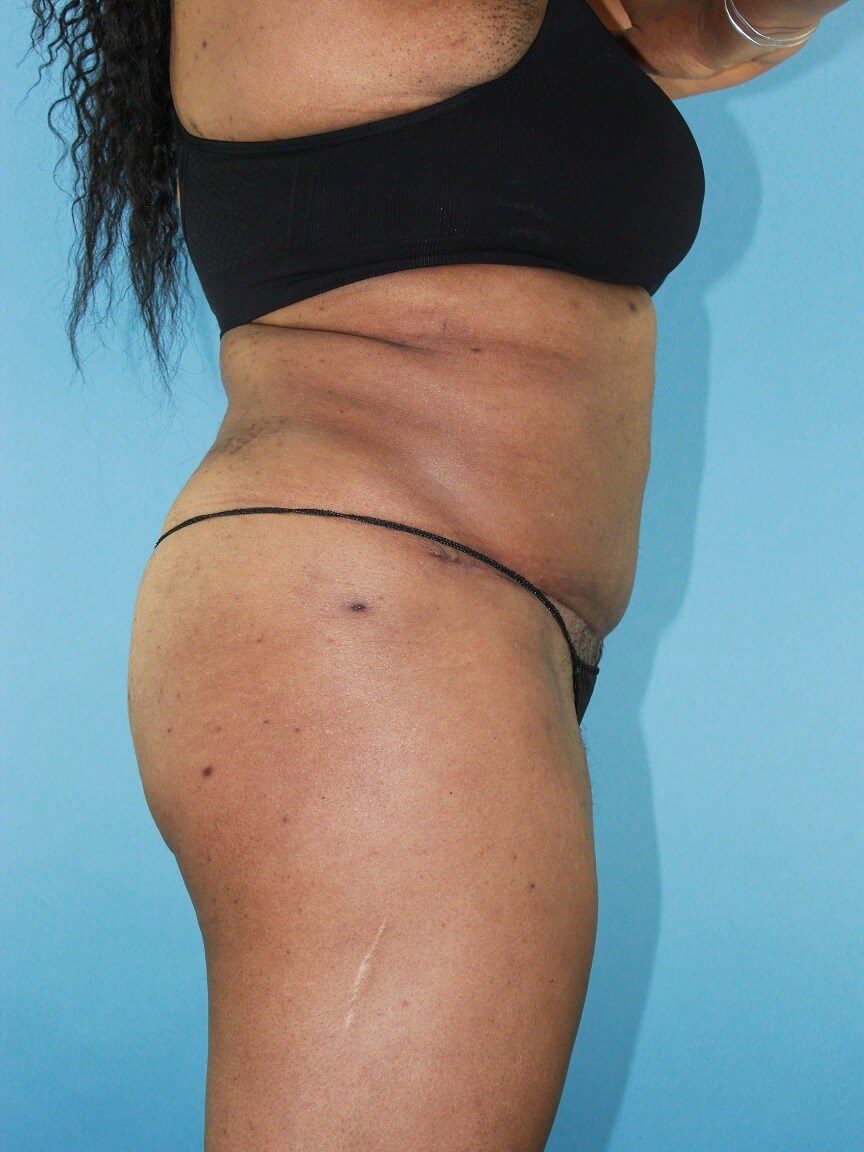 Liposuction