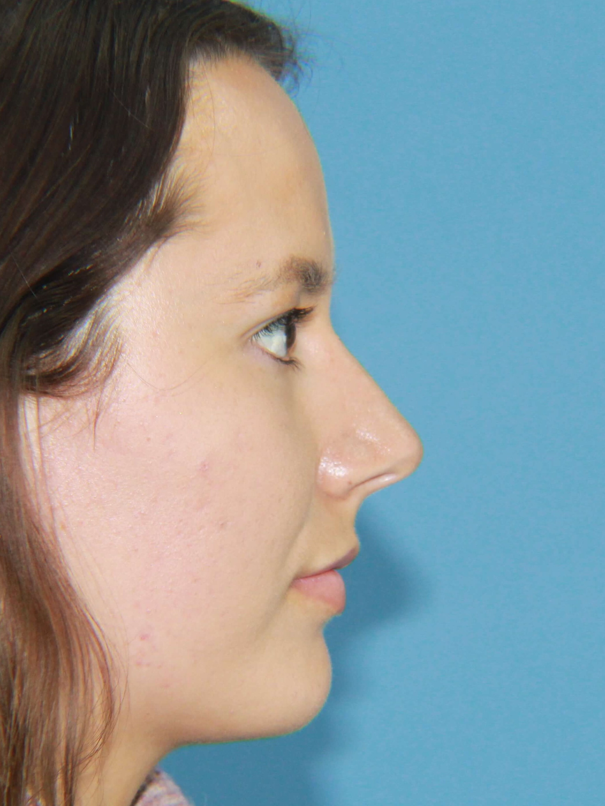 Buccal Fat Removal and V Line real patient case photo