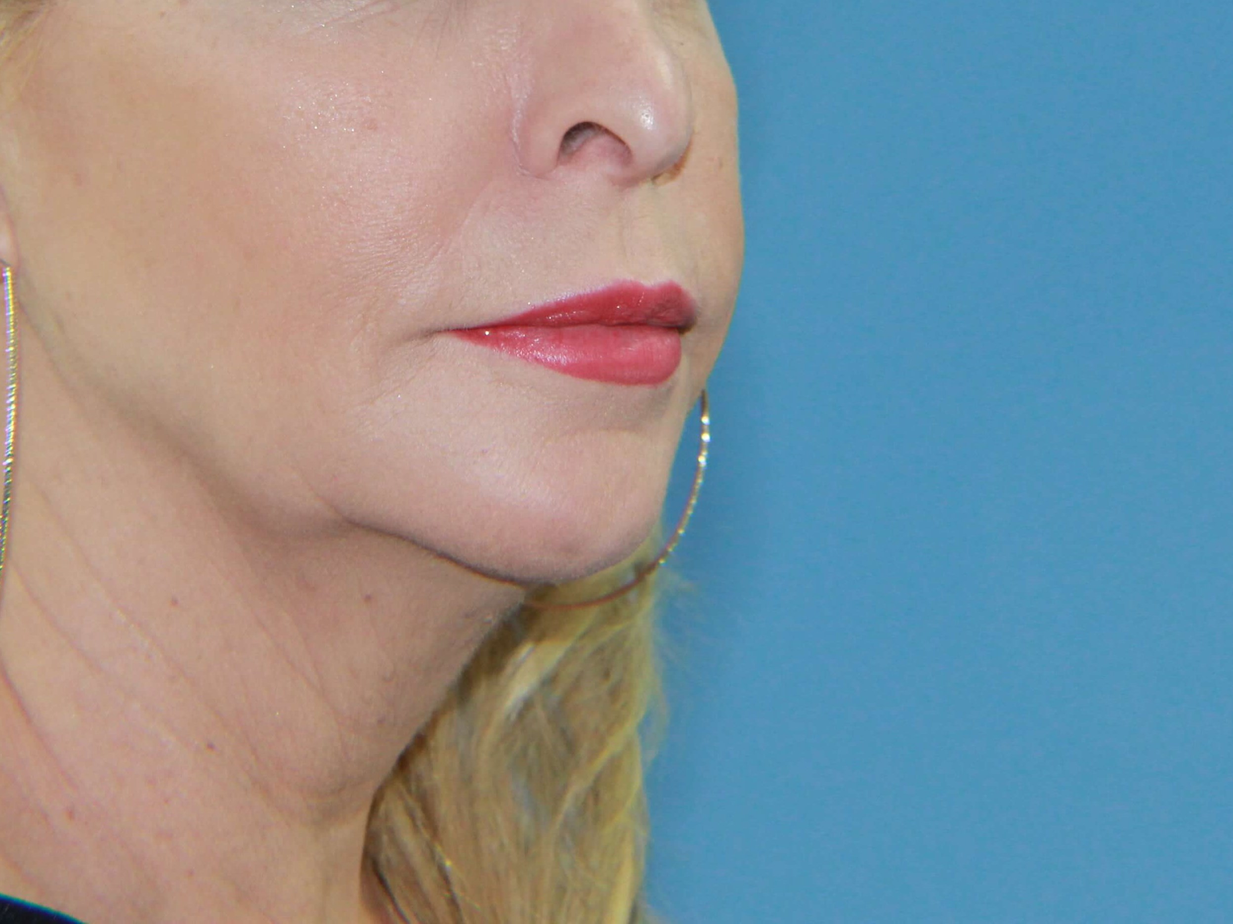 Facelift and Neck Lift real patient case photo