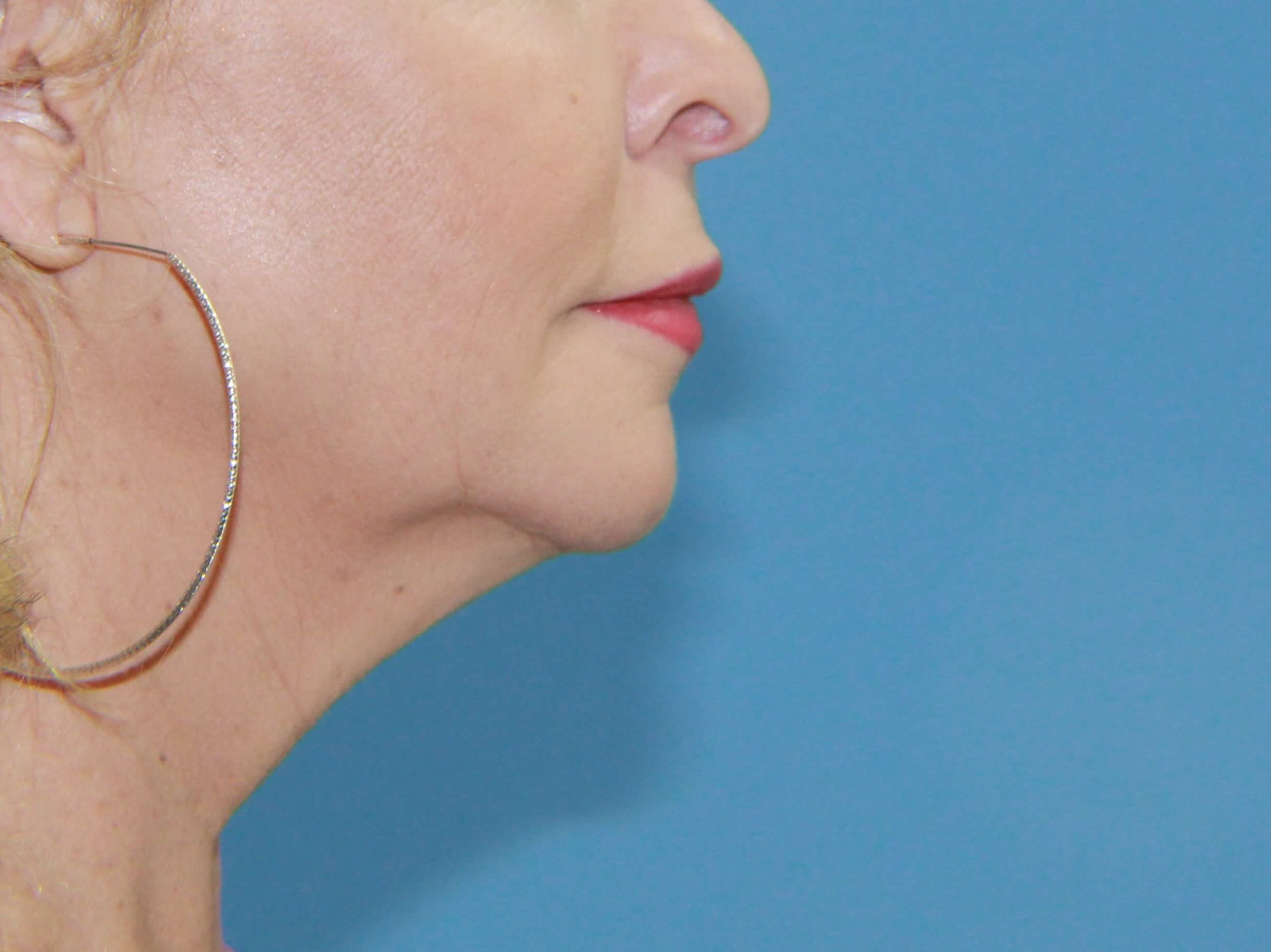 Facelift and Neck Lift