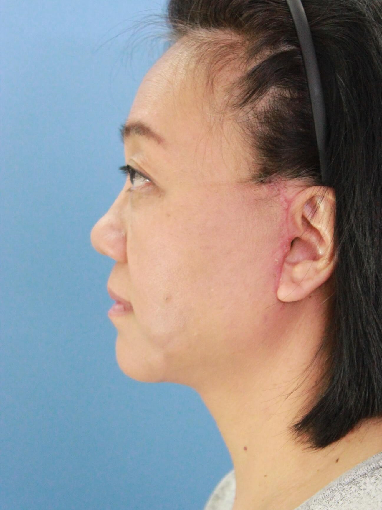 Facelift and Neck Lift