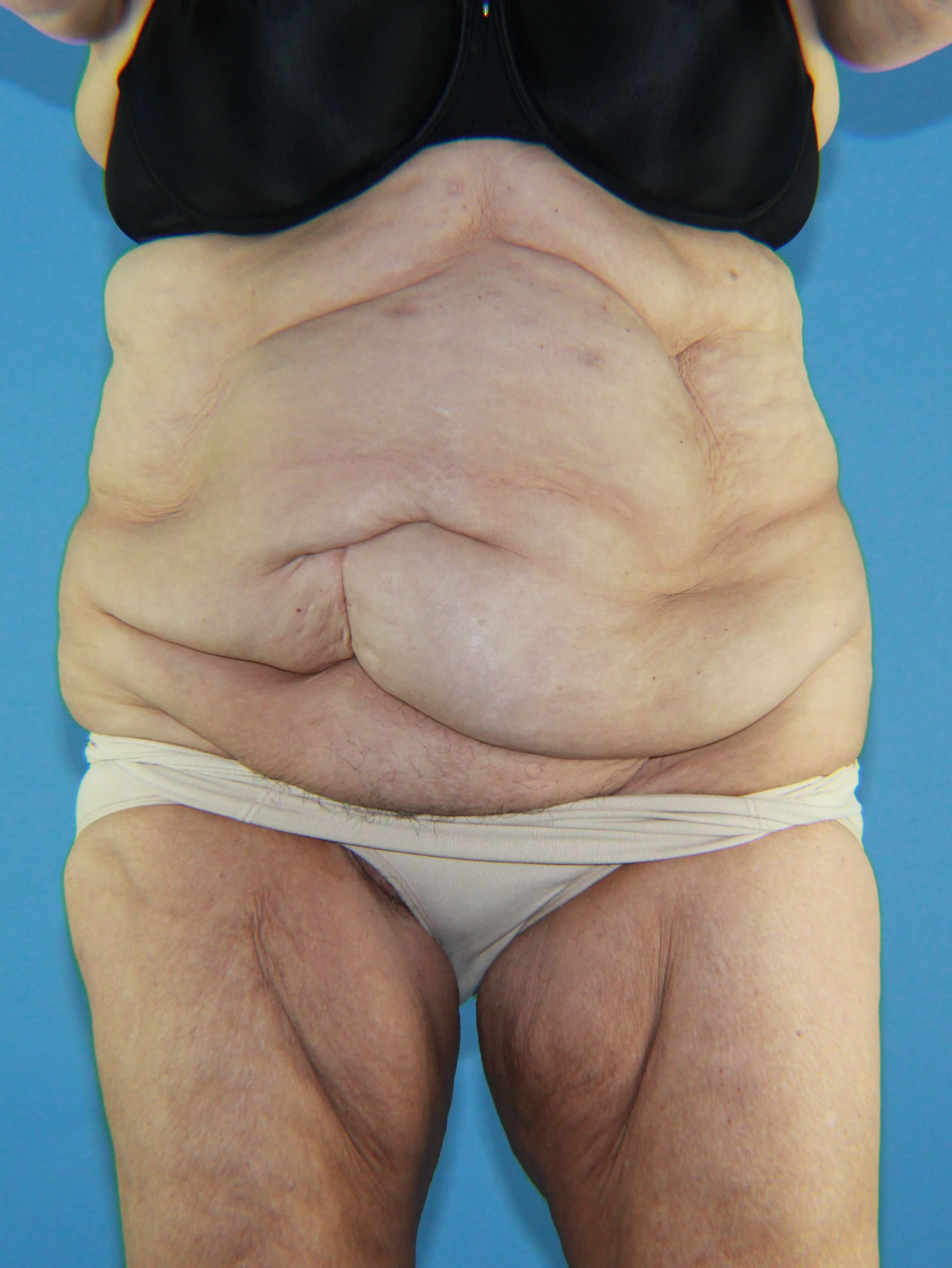 After Weight Loss Surgery