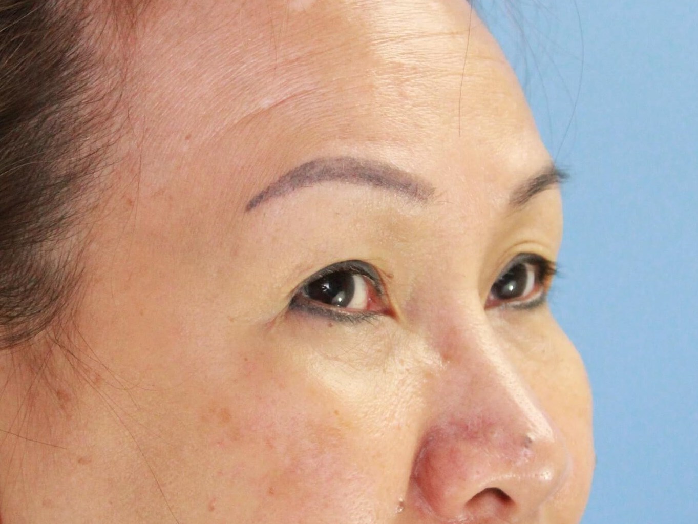 Asian Eyelid Surgery real patient case photo