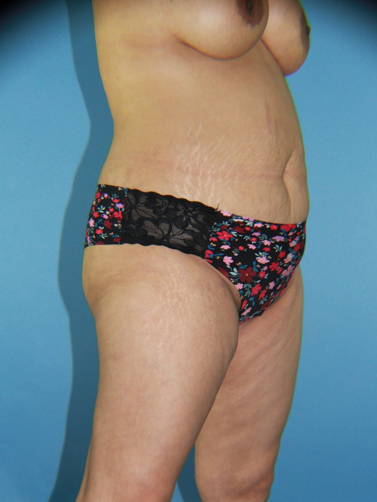 Liposuction