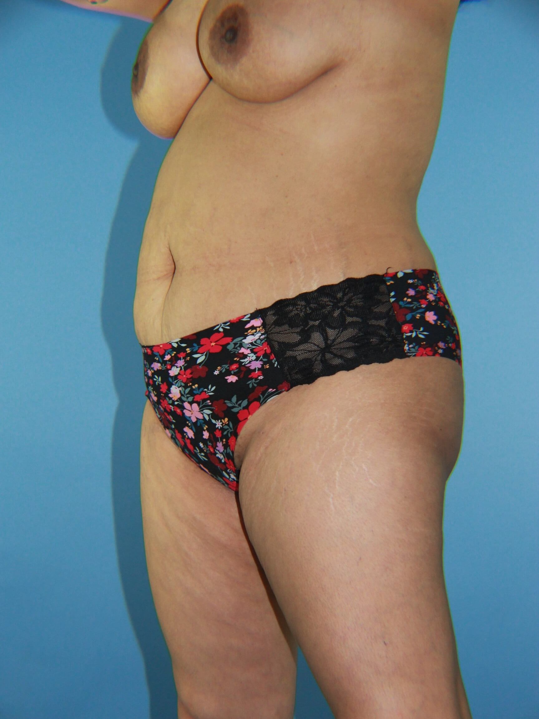 Liposuction