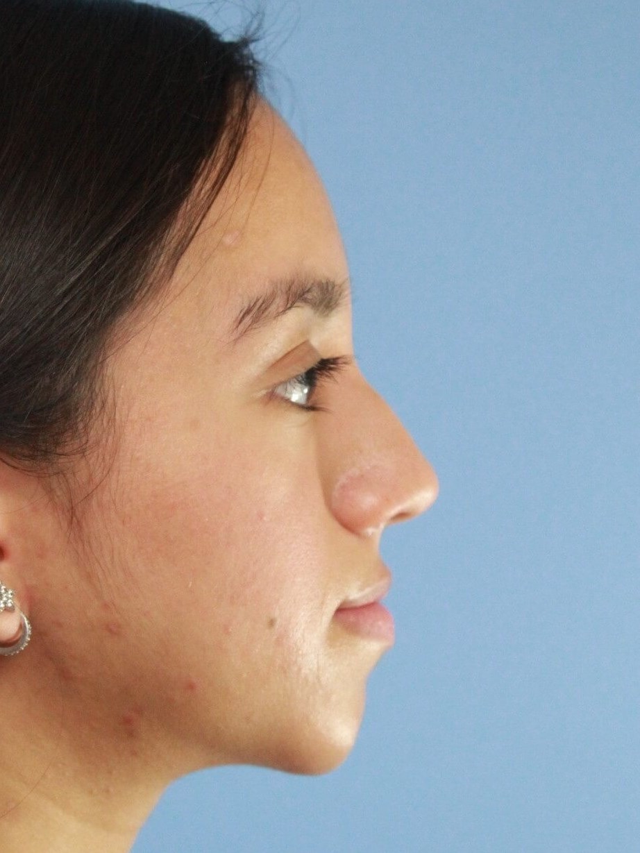 Chin Augmentation real patient case photo